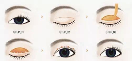 �nʽ���_(k��i)�p��Ƥ