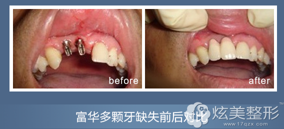 ���w��ȱʧ�����ڸ��A�Nֲ������