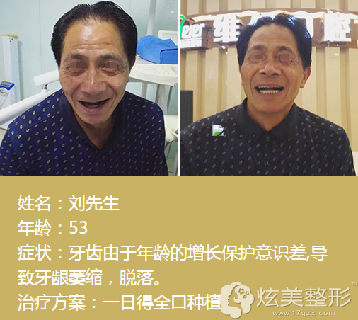 ����ȫ�ڷNֲ���r(ji��)���Ƕ���?�ļҿ�ǻ�t(y��)ԺЧ����