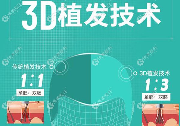 ��3dֲ�l(f��)���g(sh��)���c(di��n)��(l��i)�f(shu��)����΢�ֲ�l(f��)��FUE���g(sh��)�ą^(q��)�e��ʲô