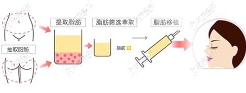 �Ͼ���֬�����õ��t(y��)��������o������ȫĘ֬�������M(f��i)��